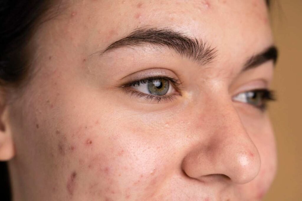 Reduce Dark Spots Naturally Treatments