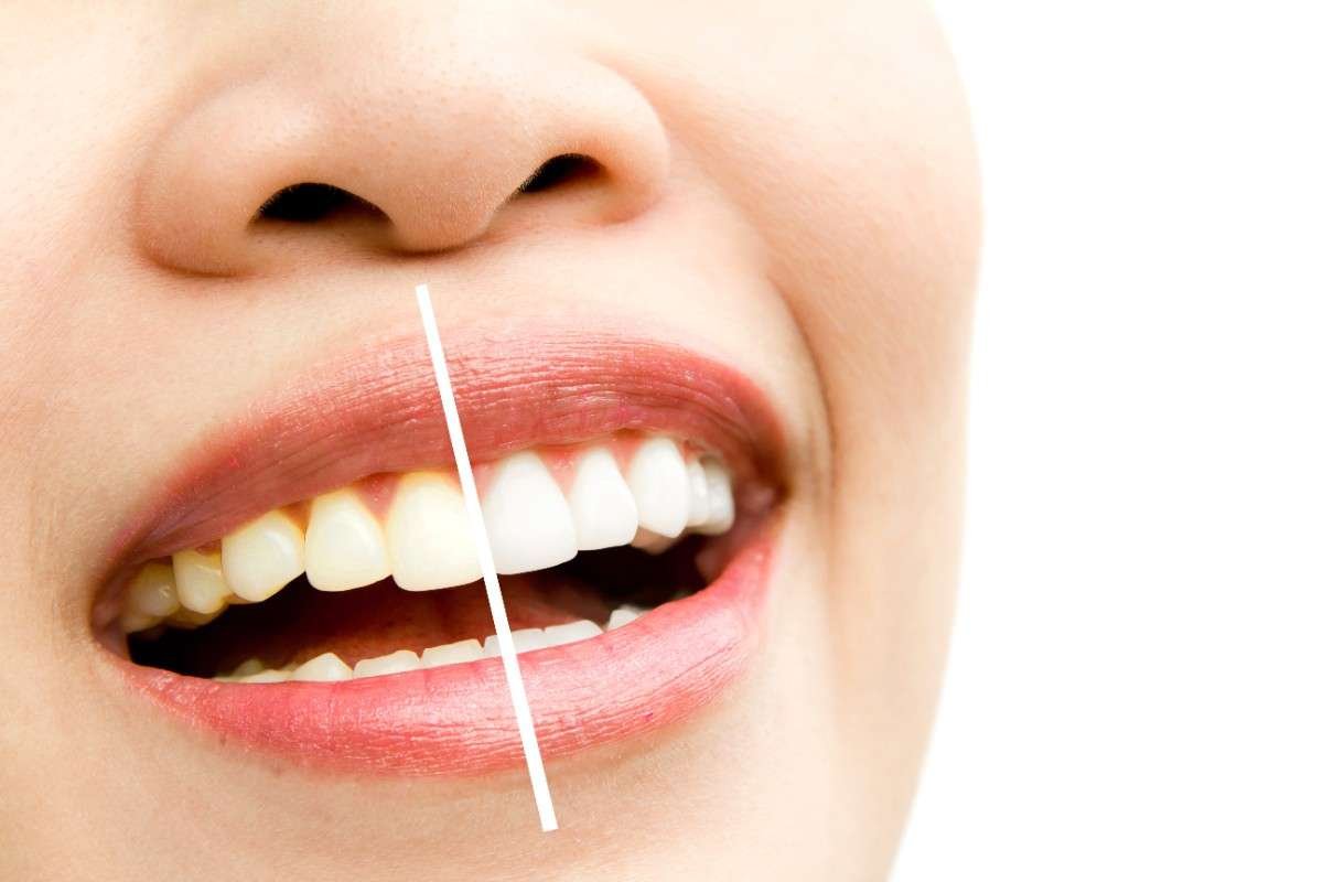 Teeth Whitening At Home teeth whitening at home